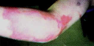 Emu Oil Used To Treat A Gasoline Burn, second picture