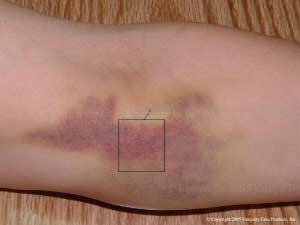 Emu Oil Products used to treat bruises!