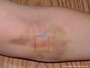 Emu Oil Products used to treat bruises!