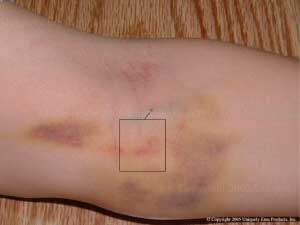 Emu Oil Products used to treat bruises!