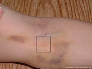Emu Oil Products used to treat bruises!