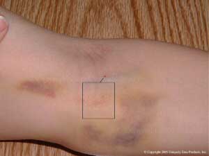 Emu Oil Products used to treat bruises!