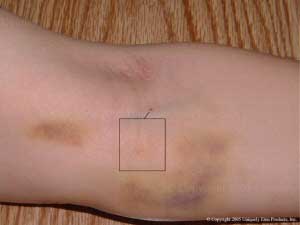 Emu Oil Products used to treat bruises!