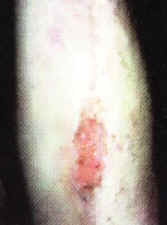 Emu Oil used for treating a gravel abrasion, second picture.